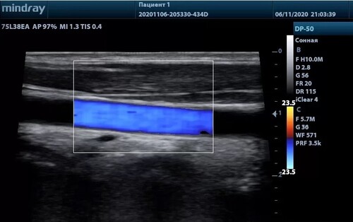 УЗИ аппарат Mindray DP-50 Color и микроконвексные датчики